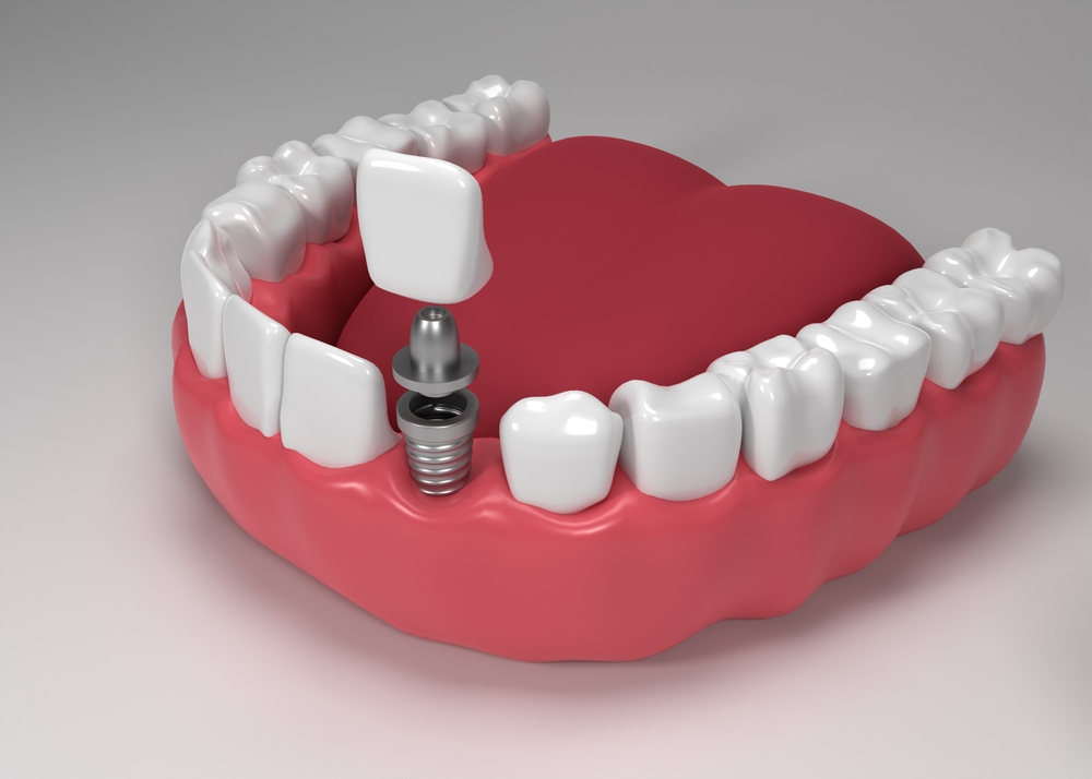 New Confidence Starts With Dental Implants in OK